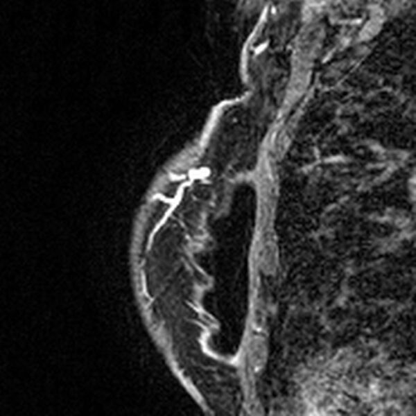 File:Breast implants - MRI (Radiopaedia 26864-27035 Sagittal T2 84).jpg