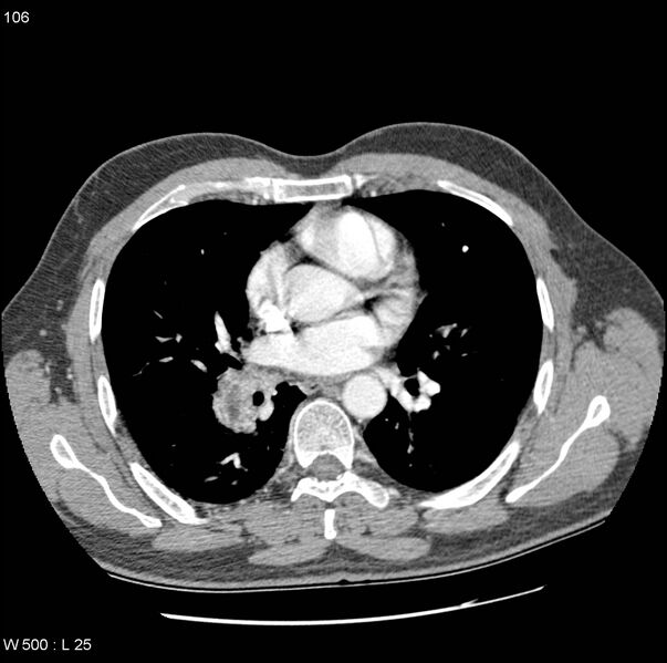 File:Bronchial arterial aneurysm (Radiopaedia 22293-22330 A 5).jpg