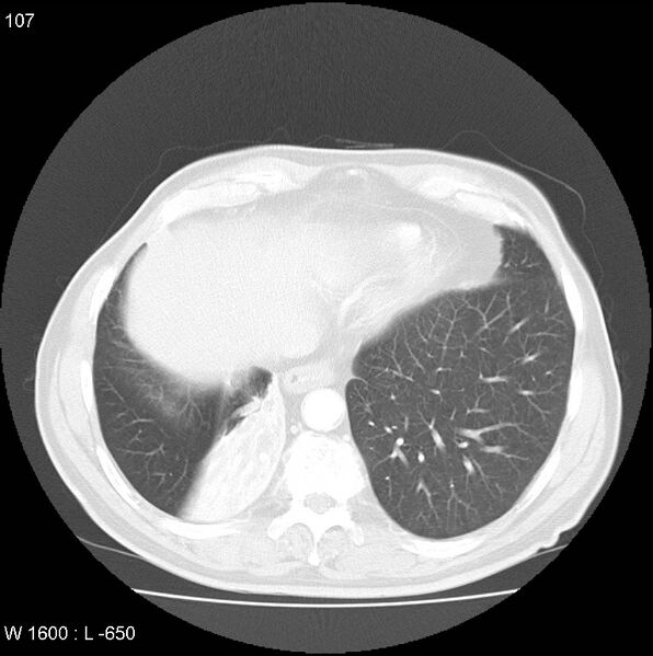 File:Bronchial carcinoid tumor with right lower lobe collapse (Radiopaedia 29060-29422 B 45).jpg
