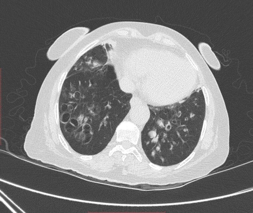 Bronchiectasis (Radiopaedia 72693-83293 Axial lung window 104).jpg