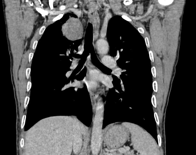 File:Bronchogenic carcinoma with superior vena cava syndrome (Radiopaedia 36497-38054 Coronal C+ delayed 57).jpg