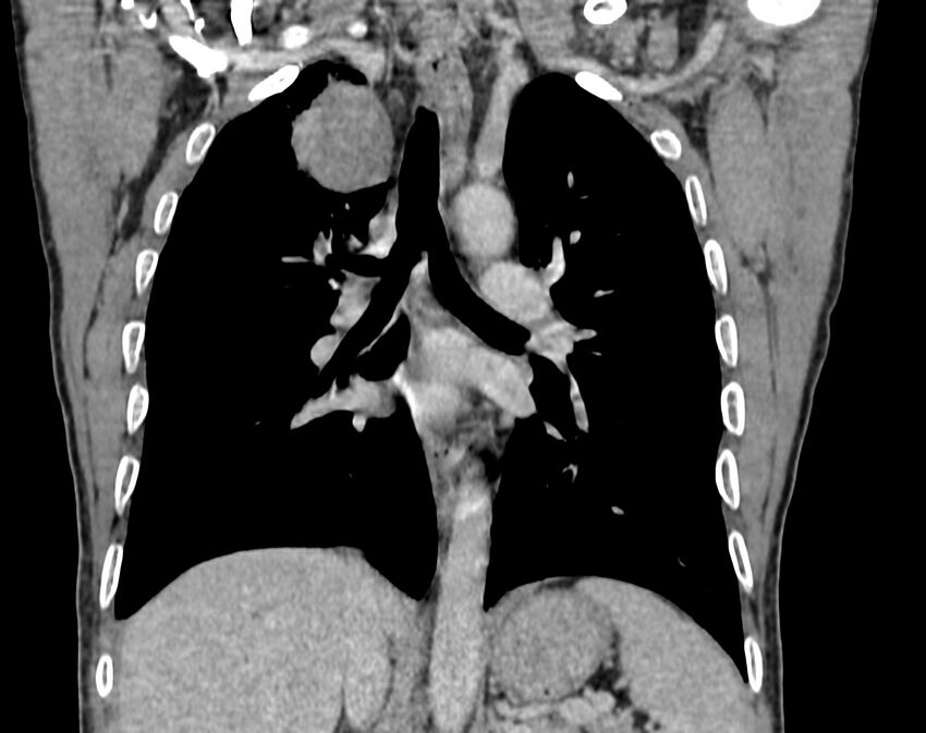 Bronchogenic carcinoma with superior vena cava syndrome (Radiopaedia 36497-38054 Coronal C+ delayed 57).jpg