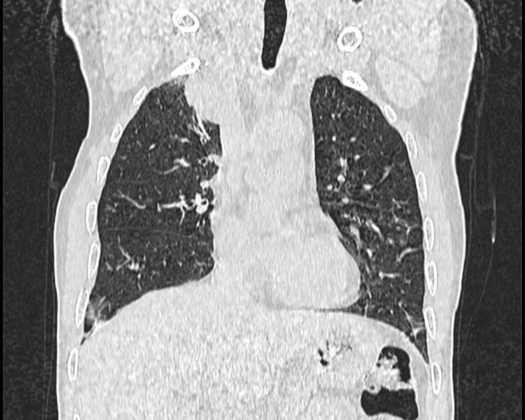 File:Bronchogenic carcinoma with superior vena cava syndrome (Radiopaedia 36497-38054 Coronal lung window 17).jpg