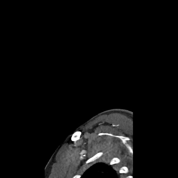 File:Buccal fat pad arteriovenous malformation (Radiopaedia 70936-81144 C 81).jpg
