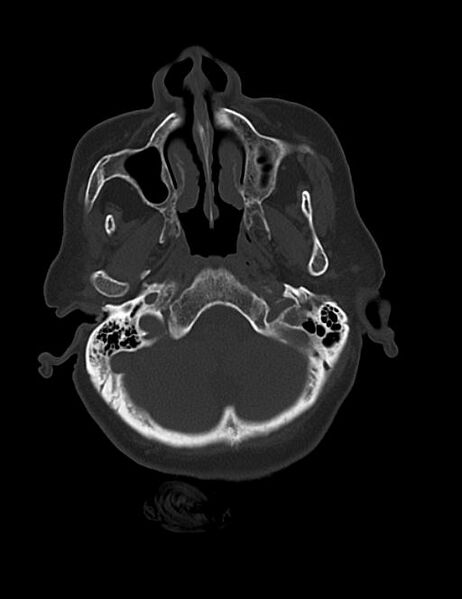 File:Burnt-out meningioma (Radiopaedia 51557-57337 Axial bone window 6).jpg