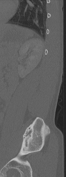 File:Burst fracture - T12 with conus compression (Radiopaedia 56825-63647 Sagittal bone window 8).png