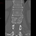 Calcaneal fracture and associated spinal injury (Radiopaedia 17896-17658 Coronal bone window 1).jpg