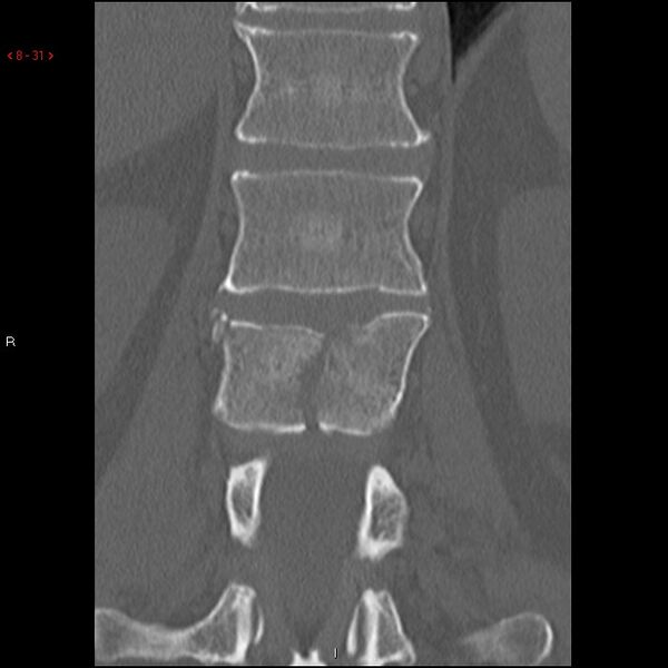 File:Calcaneal fracture and associated spinal injury (Radiopaedia 17896-17658 Coronal bone window 1).jpg