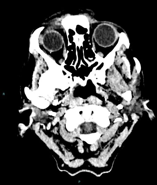 File:Calcified cerebral emboli from left ventricular thrombus (Radiopaedia 84420-99758 Axial non-contrast 85).jpg