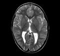 Callosal dysgenesis and ectopic posterior pituitary (Radiopaedia 8382-9213 Axial T2 7).jpg