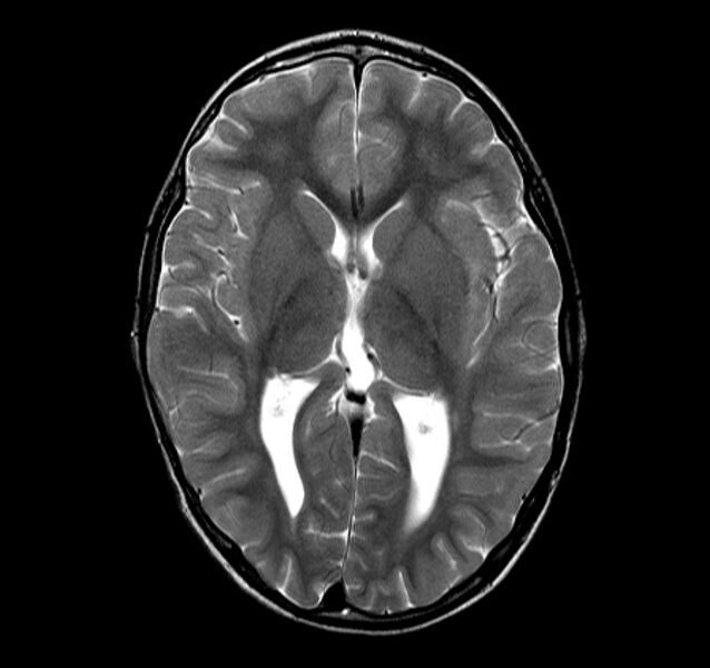 File:Callosal dysgenesis and ectopic posterior pituitary (Radiopaedia 8382-9213 Axial T2 7).jpg