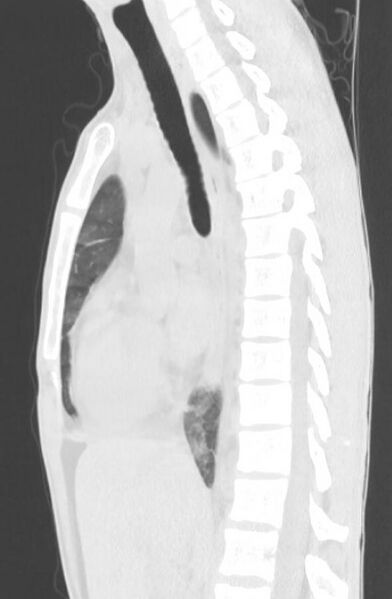 File:Cannabis-induced diffuse alveolar hemorrhage (Radiopaedia 89834-106946 Sagittal lung window 70).jpg