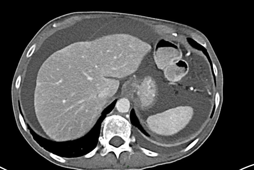 Carcinoid mesenteric tumor complicated by chylous ascites (Radiopaedia 76312-87953 A 11).jpg