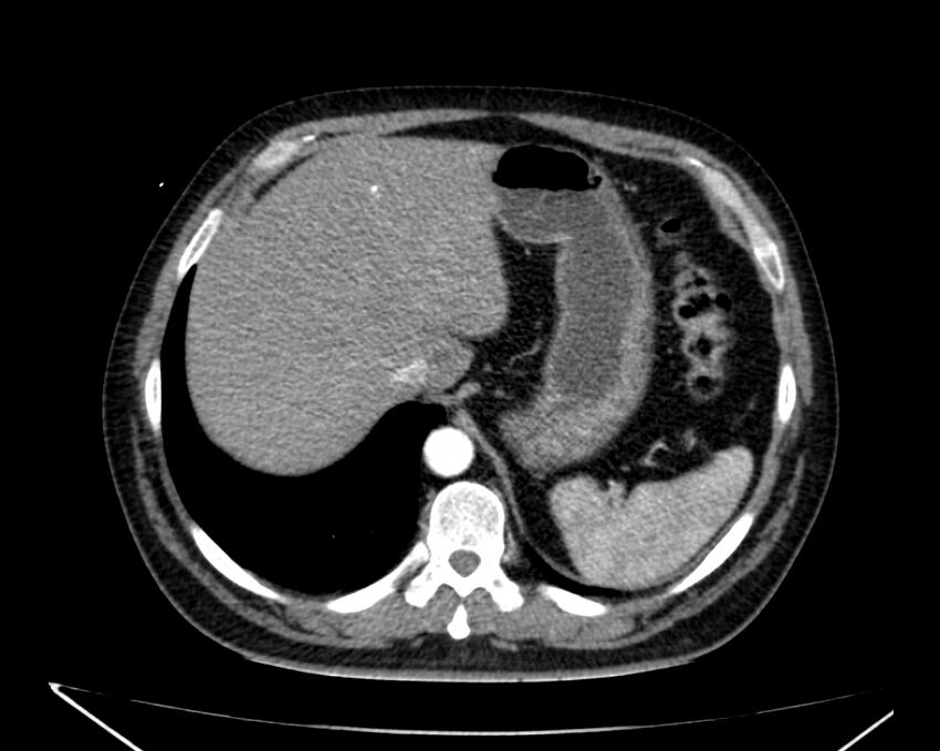 Carcinoid tumor with hepatic metastases (Radiopaedia 22651-22670 B 16).jpg