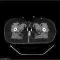 Carcinoma cervix- brachytherapy applicator (Radiopaedia 33135-34173 Axial non-contrast 59).jpg