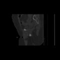 Carcinoma cervix- brachytherapy applicator (Radiopaedia 33135-34173 Sagittal bone window 51).jpg