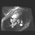 Cardiac fibroma (Radiopaedia 38974-41150 4 chamber FGRET 14).jpg