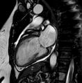 Cardiac sarcoidosis (Radiopaedia 74548-85535 2ch Cine SSFP 4).jpg