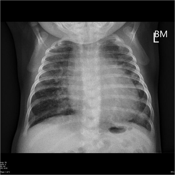 File:Cardiomegaly with plethora and edema (Radiopaedia 24086).jpg