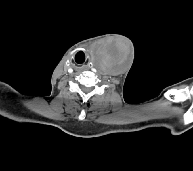File:Carotid artery pseudoaneurysm (Radiopaedia 84030-99259 C 55).jpg