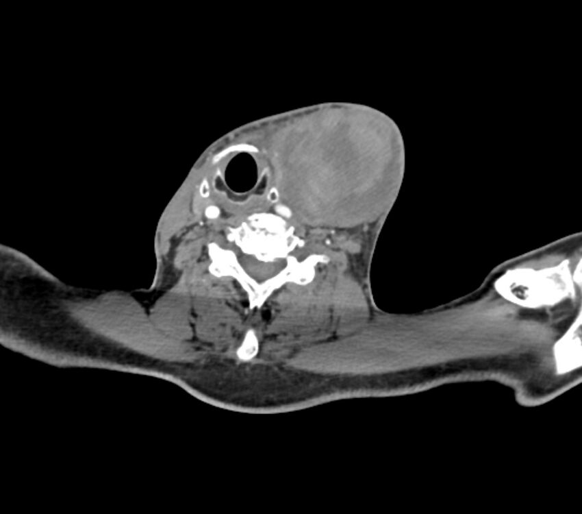 Carotid artery pseudoaneurysm (Radiopaedia 84030-99259 C 55).jpg