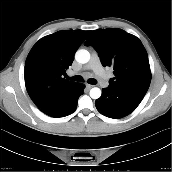 File:Cavitating lung cancer (Radiopaedia 25796-25945 C+ arterial phase 22).jpg