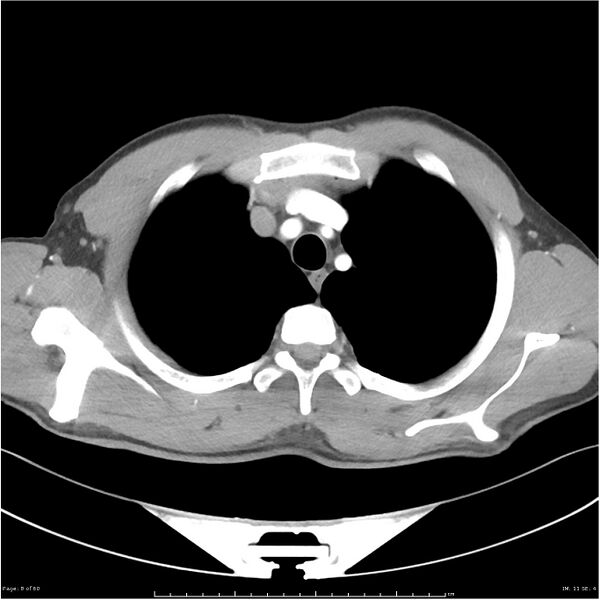 File:Cavitating lung cancer (Radiopaedia 25796-25945 C+ arterial phase 8).jpg