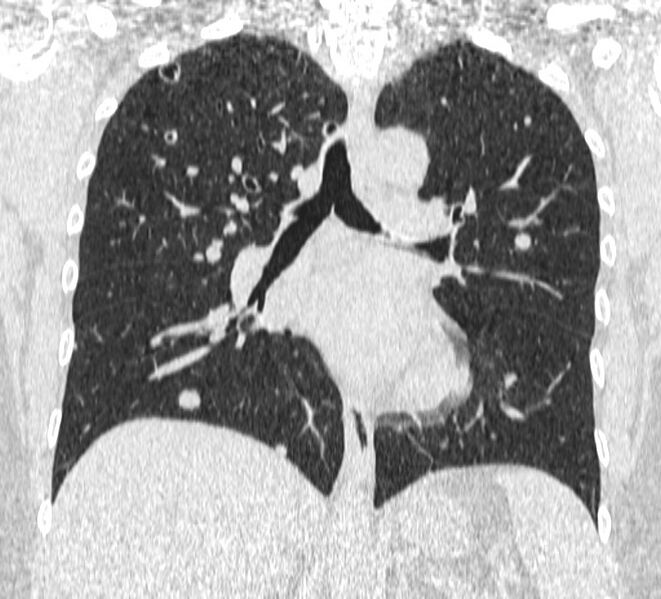 File:Cavitating pulmonary metastases (Radiopaedia 17796-17555 Coronal lung window 14).jpg