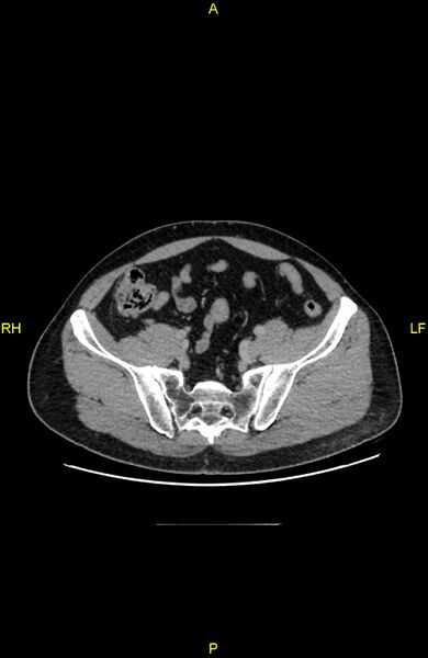 File:Cecal epiploic appendagitis (Radiopaedia 86047-102164 A 117).jpg