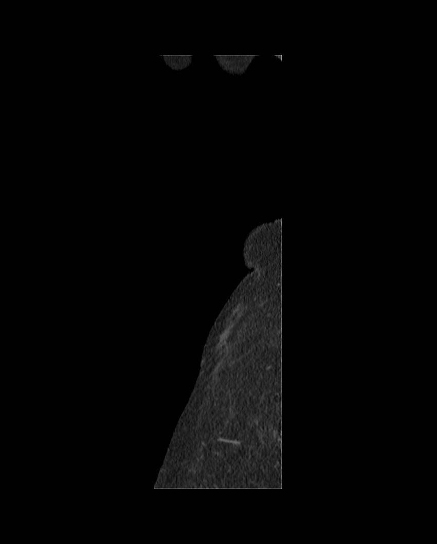 Cecal volvulus (Radiopaedia 54998-61310 C 84).jpg