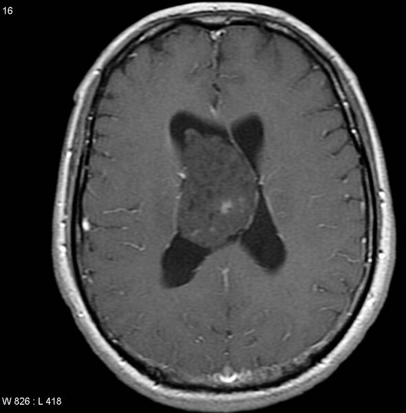 File:Central neurocytoma (Radiopaedia 4956-6850 Axial T1 C+ 1).jpg