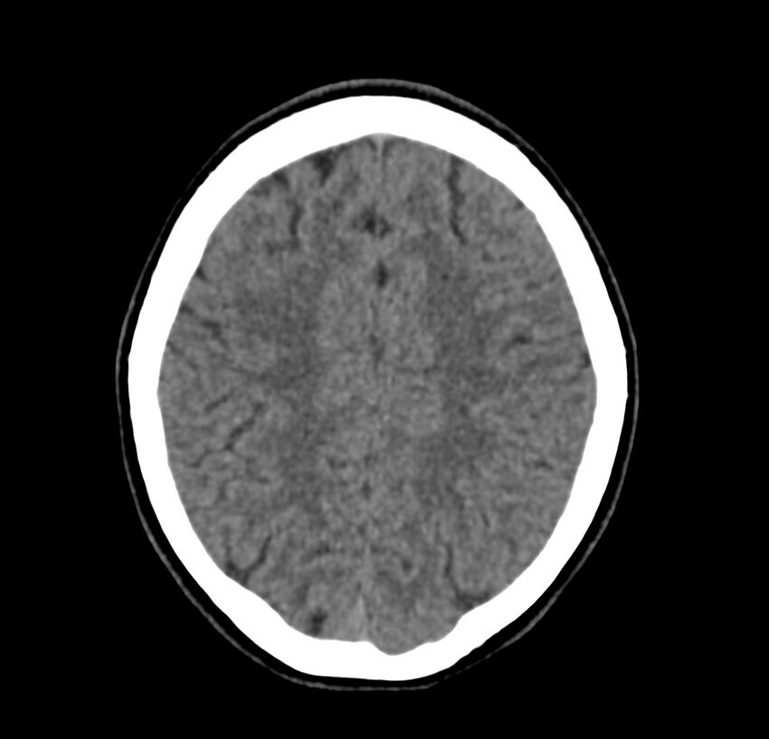 Cerebellar agenesis (Radiopaedia 30203-30817 Axial non-contrast 37).jpg
