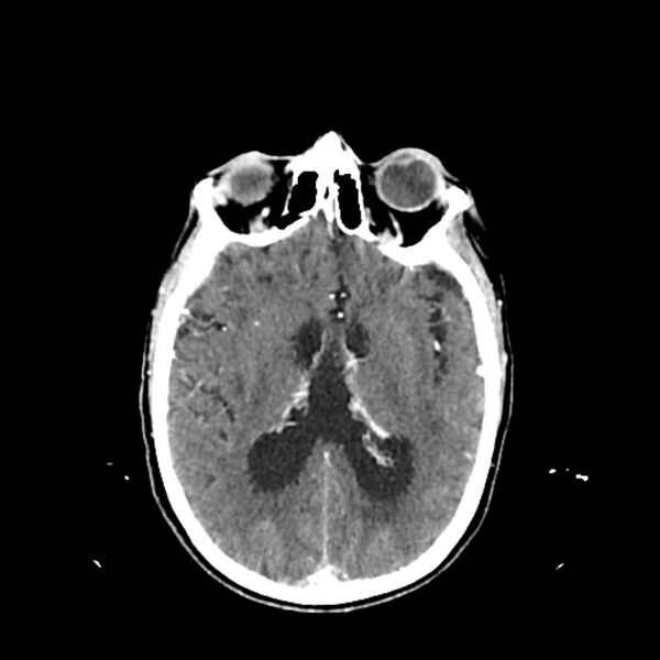 File:Cerebellar metastasis - lung tumor (Radiopaedia 69317-79145 Axial with contrast 22).jpg