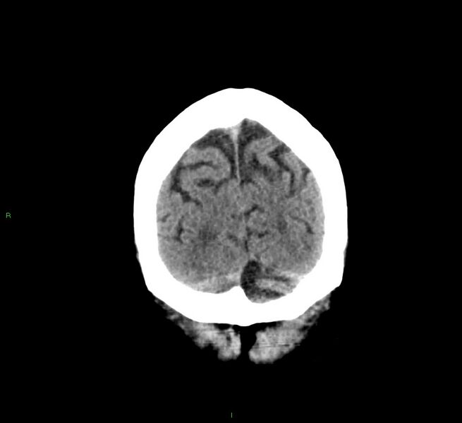 File:Cerebral amyloid angiopathy-associated lobar intracerebral hemorrhage (Radiopaedia 58376-65511 Coronal non-contrast 11).jpg