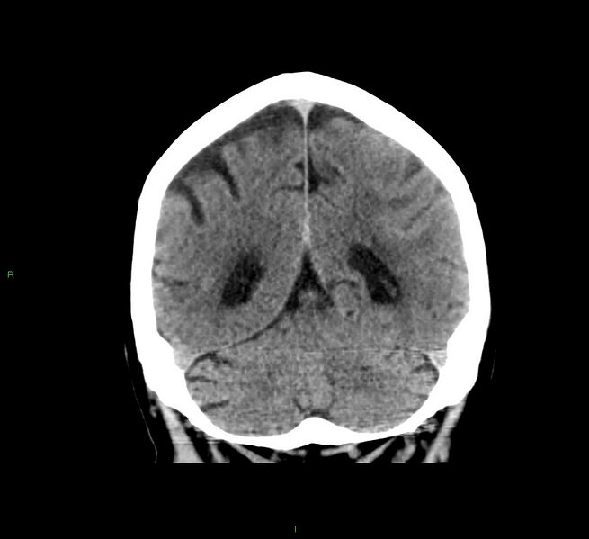 File:Cerebral amyloid angiopathy-associated lobar intracerebral hemorrhage (Radiopaedia 58376-65511 Coronal non-contrast 21).jpg