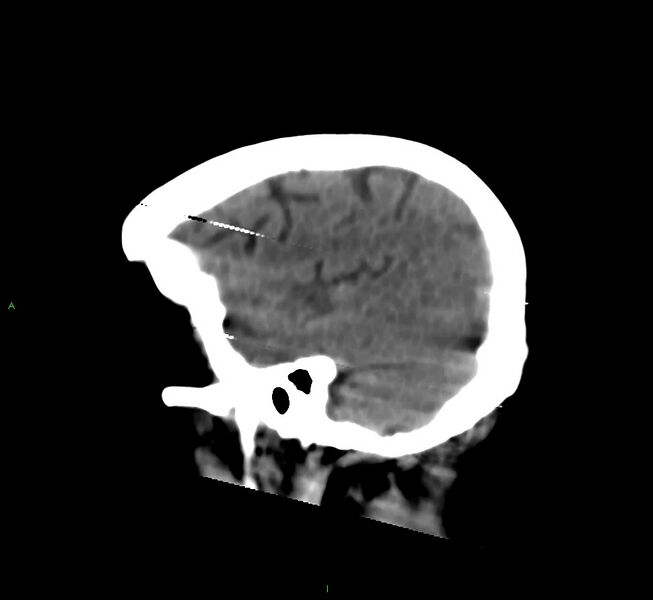 File:Cerebral amyloid angiopathy-associated lobar intracerebral hemorrhage (Radiopaedia 58377-65514 B 10).jpg