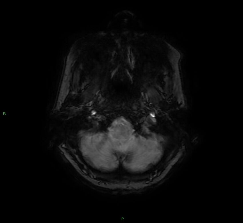 Cerebral amyloid angiopathy-associated lobar intracerebral hemorrhage (Radiopaedia 58378-65517 Axial SWI 9).jpg
