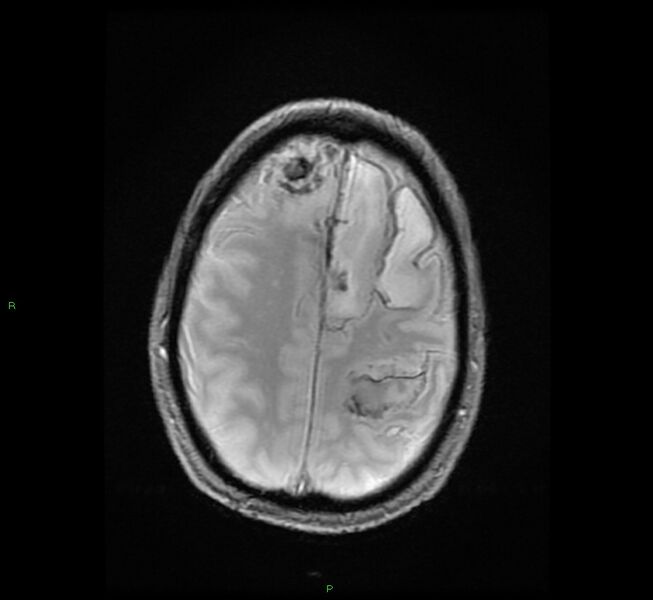 File:Cerebral amyloid angiopathy-associated lobar intracerebral hemorrhage (Radiopaedia 58529-65684 Axial Gradient Echo 20).jpg