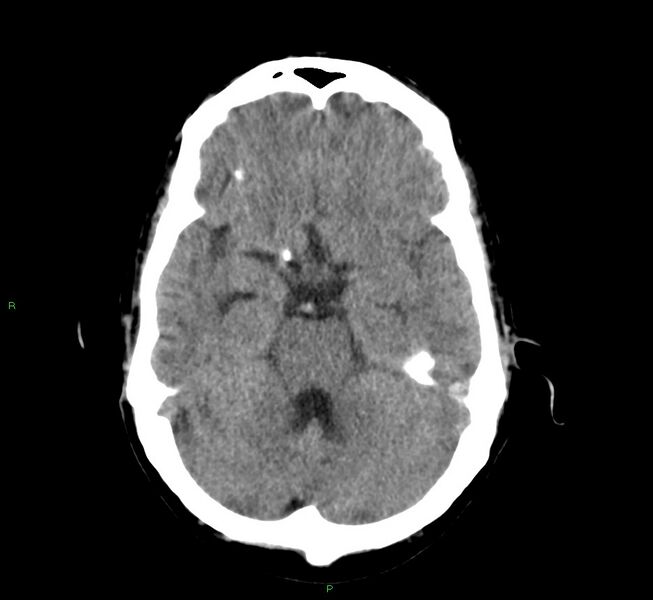 File:Cerebral amyloid angiopathy-associated lobar intracerebral hemorrhage (Radiopaedia 58529-65686 Axial non-contrast 8).jpg