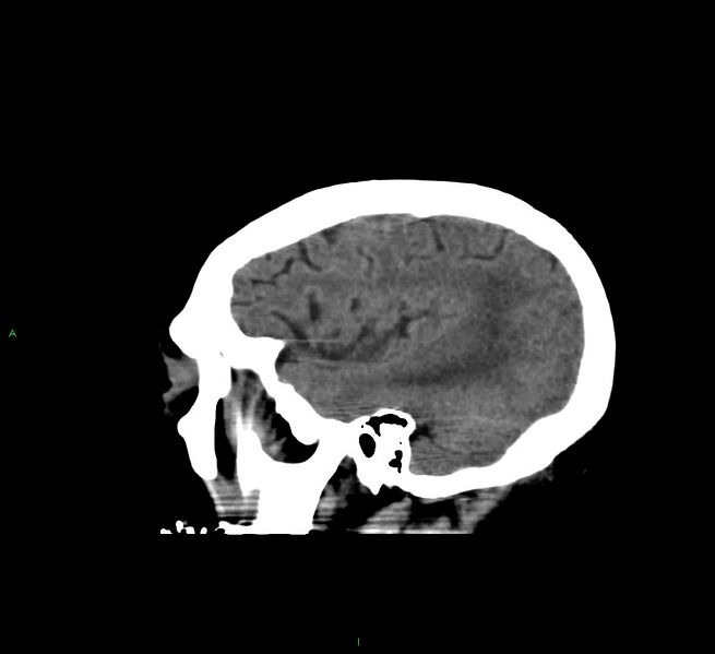 File:Cerebral amyloid angiopathy-associated lobar intracerebral hemorrhage (Radiopaedia 58560-65723 C 41).jpg