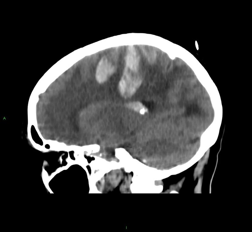 Cerebral amyloid angiopathy-associated lobar intracerebral hemorrhage (Radiopaedia 58566-65730 C 20).jpg
