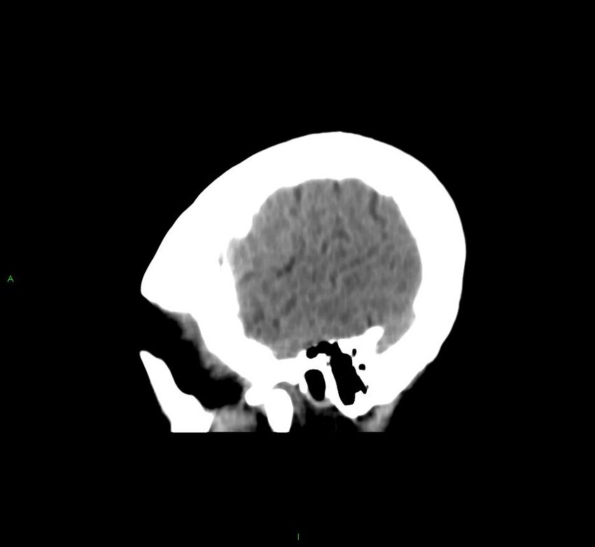 Cerebral amyloid angiopathy-associated lobar intracerebral hemorrhage (Radiopaedia 58566-65730 C 44).jpg