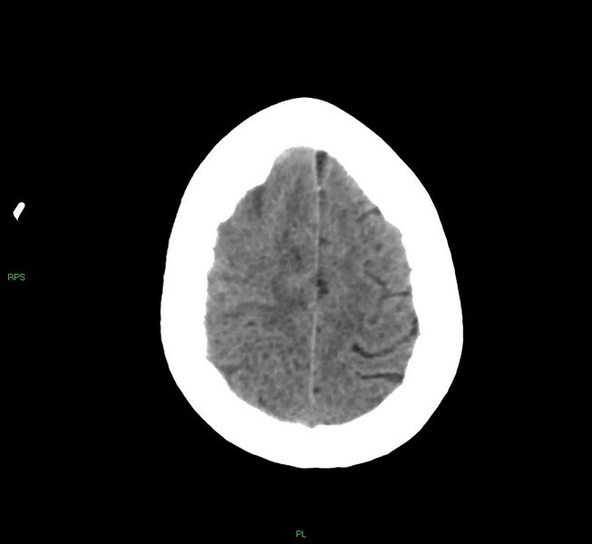 File:Cerebral amyloid angiopathy-associated lobar intracerebral hemorrhage (Radiopaedia 58569-65734 Axial non-contrast 17).jpg