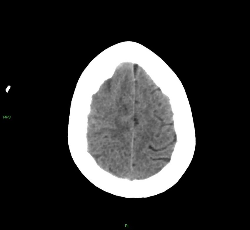 Cerebral amyloid angiopathy-associated lobar intracerebral hemorrhage (Radiopaedia 58569-65734 Axial non-contrast 17).jpg