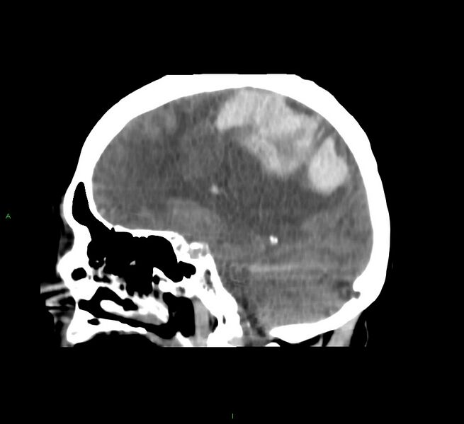 File:Cerebral amyloid angiopathy-associated lobar intracerebral hemorrhage (Radiopaedia 58751-65972 C 25).jpg