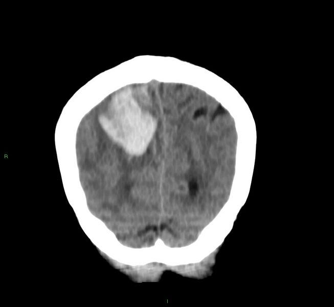 File:Cerebral amyloid angiopathy-associated lobar intracerebral hemorrhage (Radiopaedia 58751-65972 Coronal non-contrast 12).jpg