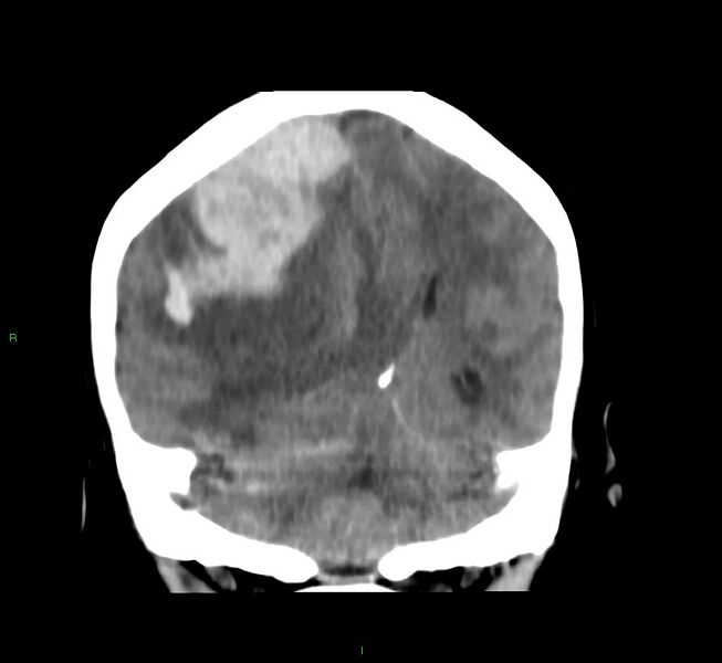 File:Cerebral amyloid angiopathy-associated lobar intracerebral hemorrhage (Radiopaedia 58751-65972 Coronal non-contrast 25).jpg