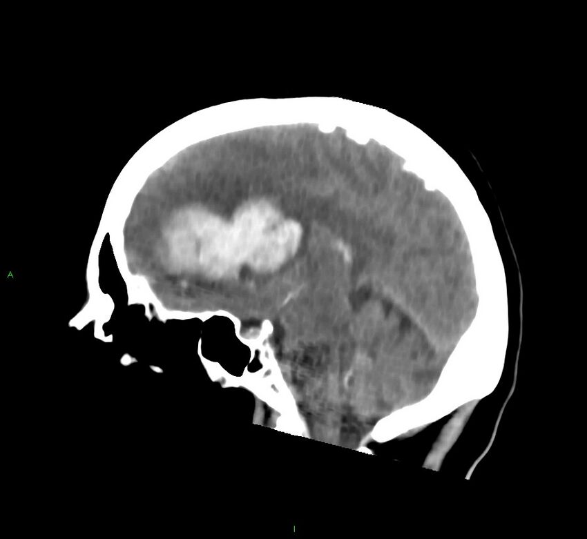 Cerebral amyloid angiopathy-associated lobar intracerebral hemorrhage (Radiopaedia 58752-65973 C 29).jpg