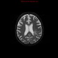 Cerebral and orbital tuberculomas (Radiopaedia 13308-13311 Axial T2 14).jpg