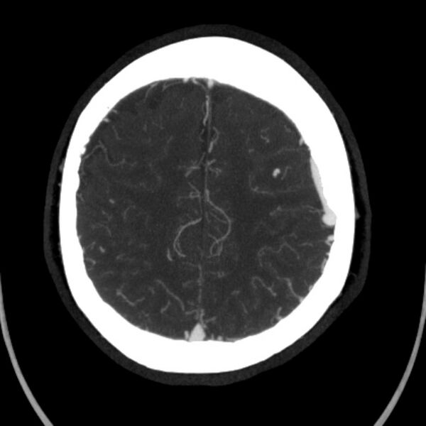 File:Cerebral arteriovenous malformation (Radiopaedia 43729-47189 B 38).jpg